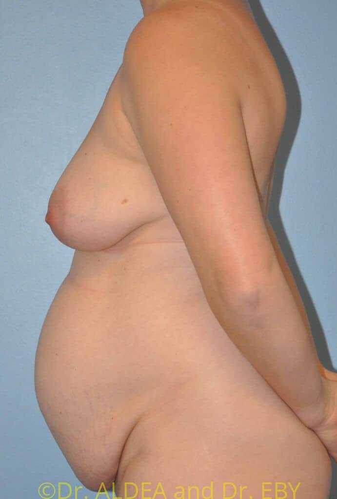 Before Image: Tummy Tuck #982 - left-side