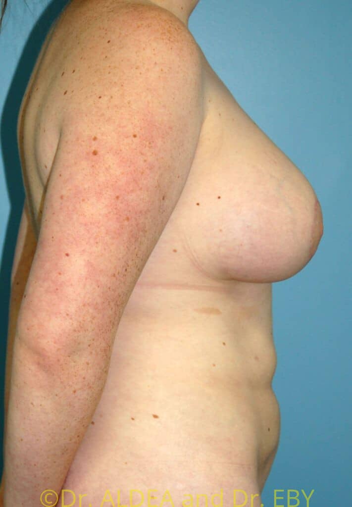 After Image: Breast Augmentation w/ Lift #426 - right-side