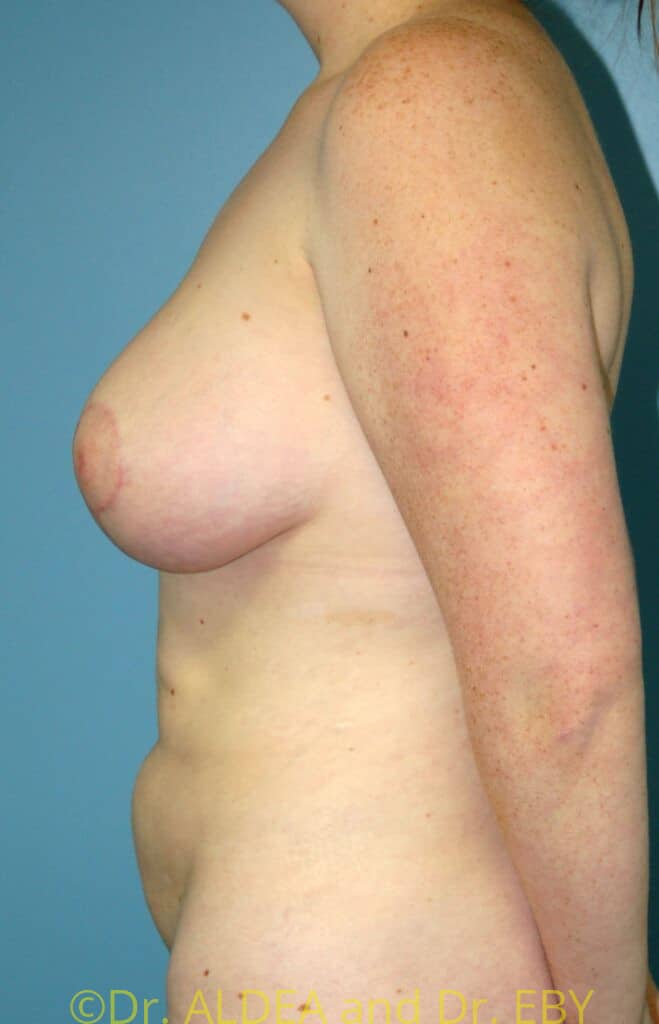 After Image: Breast Augmentation w/ Lift #426 - left-side