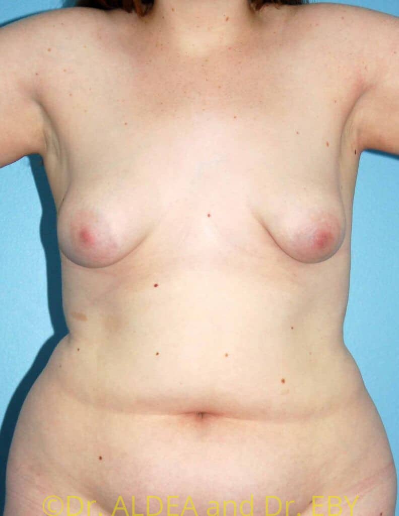Before Image: Breast Augmentation w/ Lift #426 - front