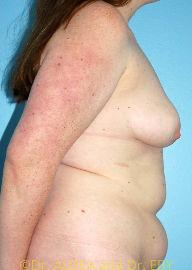 Before Image: Breast Augmentation w/ Lift #426 - right-side