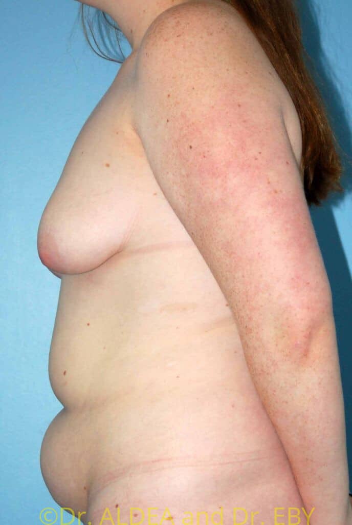 Before Image: Breast Augmentation w/ Lift #426 - left-side
