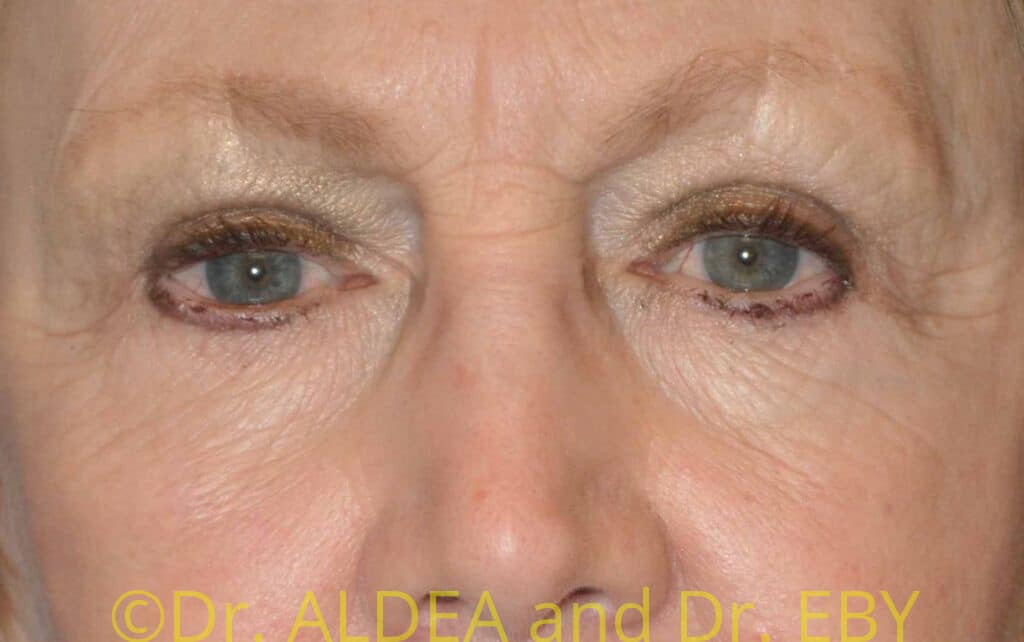 After Image: Blepharoplasty #561 - front