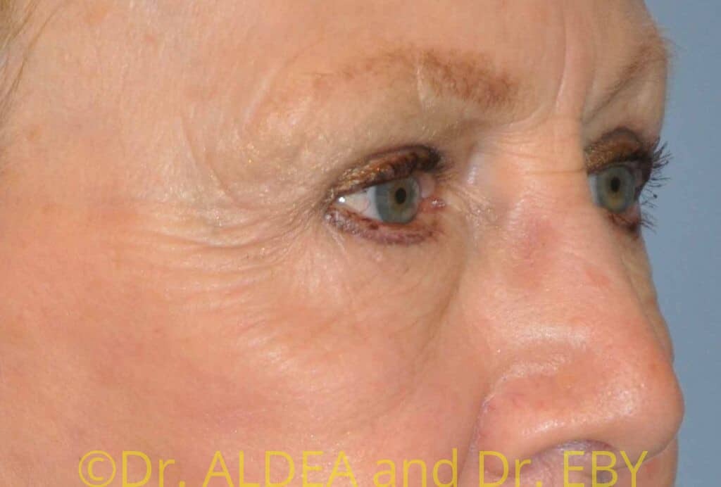 After Image: Blepharoplasty #561 - right-front-oblique