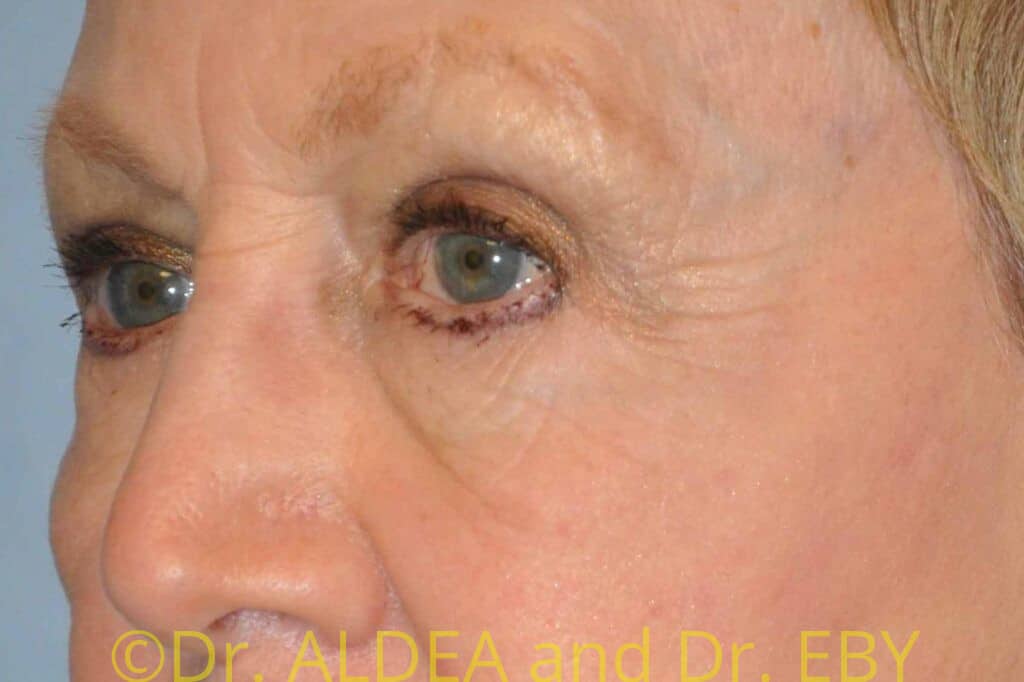 After Image: Blepharoplasty #561 - left-front-oblique