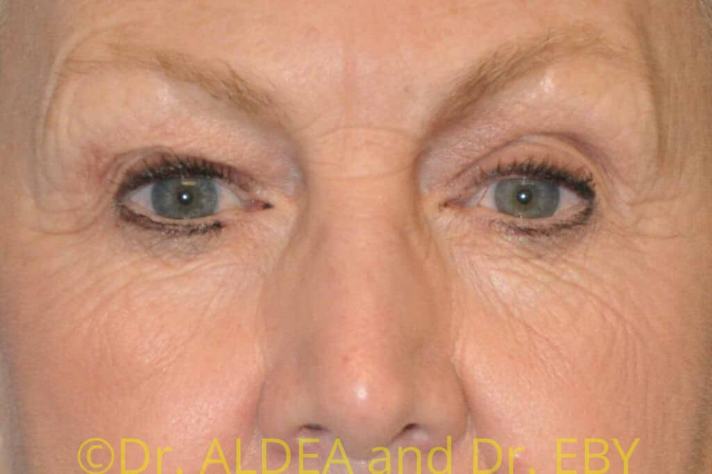 Before Image: Blepharoplasty #561 - front