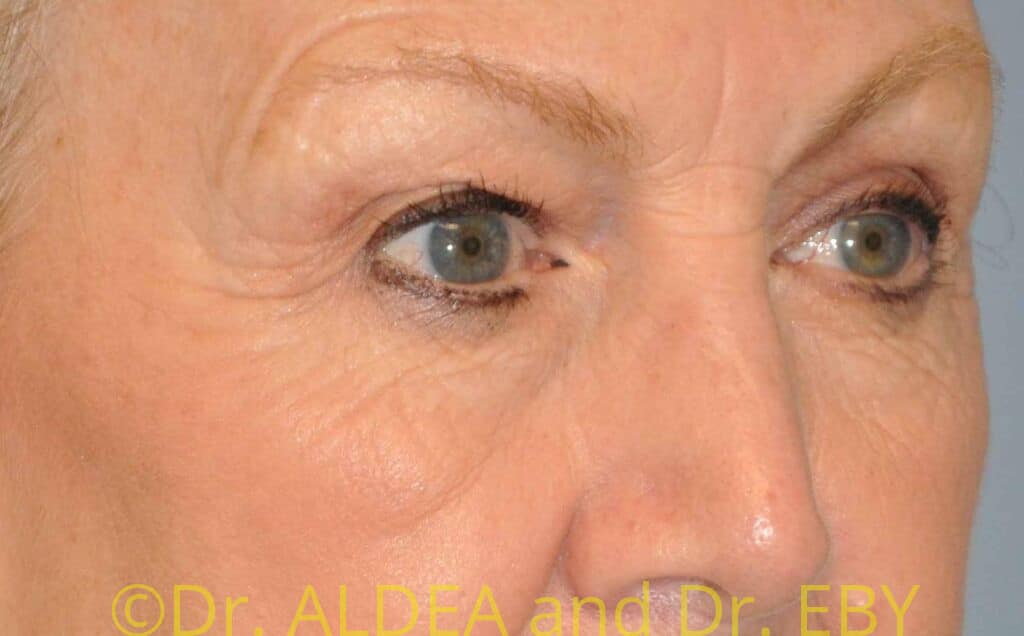 Before Image: Blepharoplasty #561 - right-front-oblique