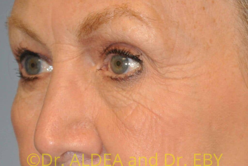 Before Image: Blepharoplasty #561 - left-front-oblique