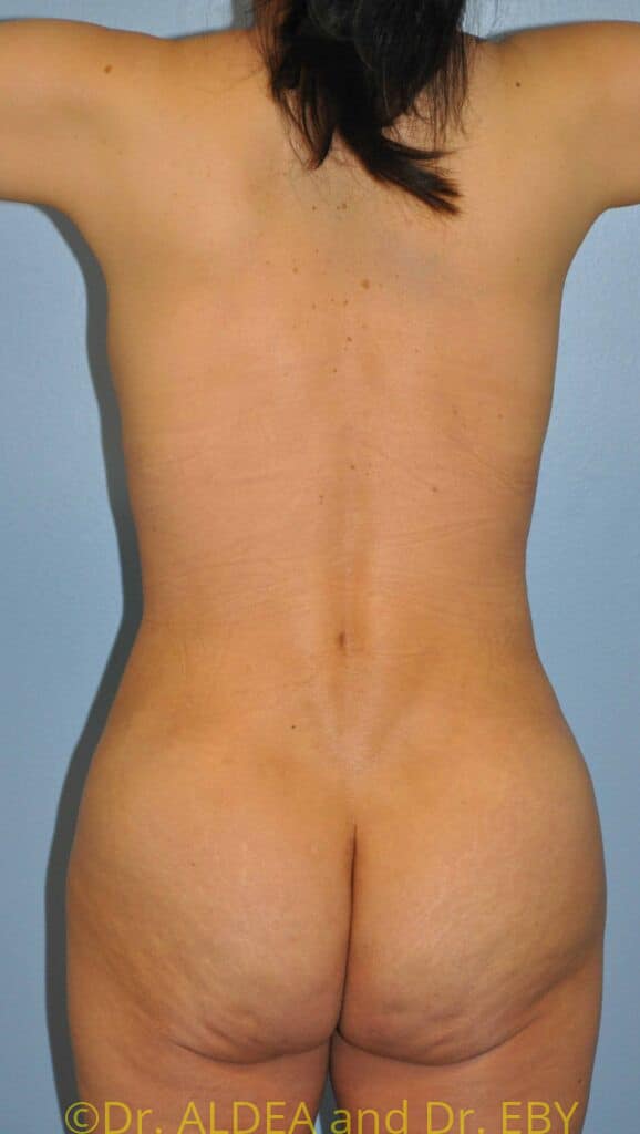 After Image: Back Scoop Liposuction #318 - back