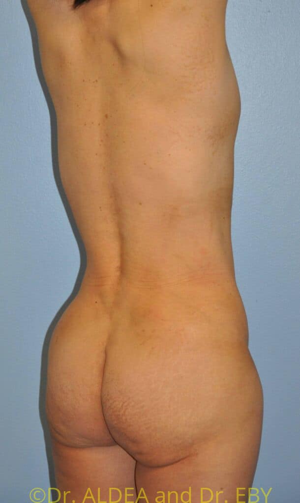 After Image: Back Scoop Liposuction #318 - right-back-oblique