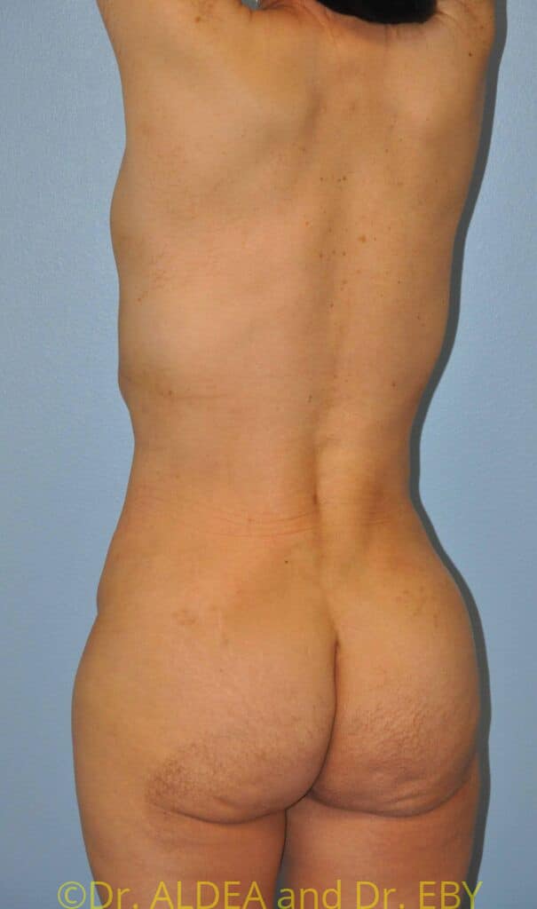 After Image: Back Scoop Liposuction #318 - left-back-oblique