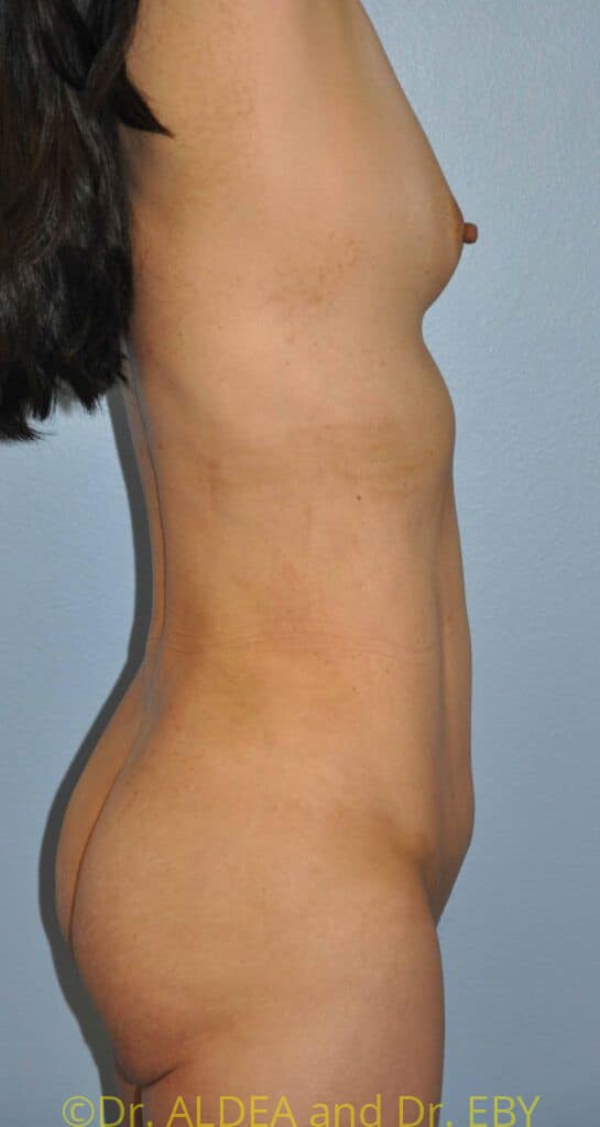 After Image: Back Scoop Liposuction #318 - right-side