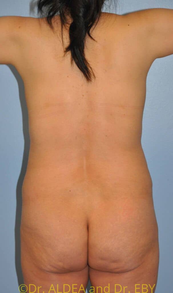 Before Image: Back Scoop Liposuction #318 - back