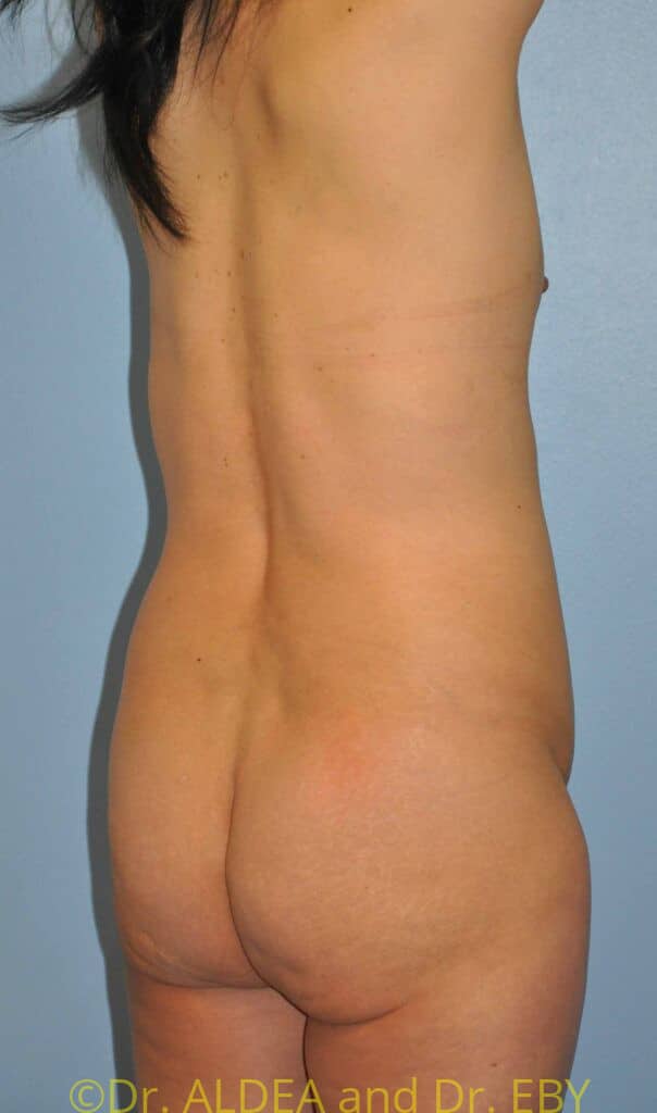Before Image: Back Scoop Liposuction #318 - right-back-oblique