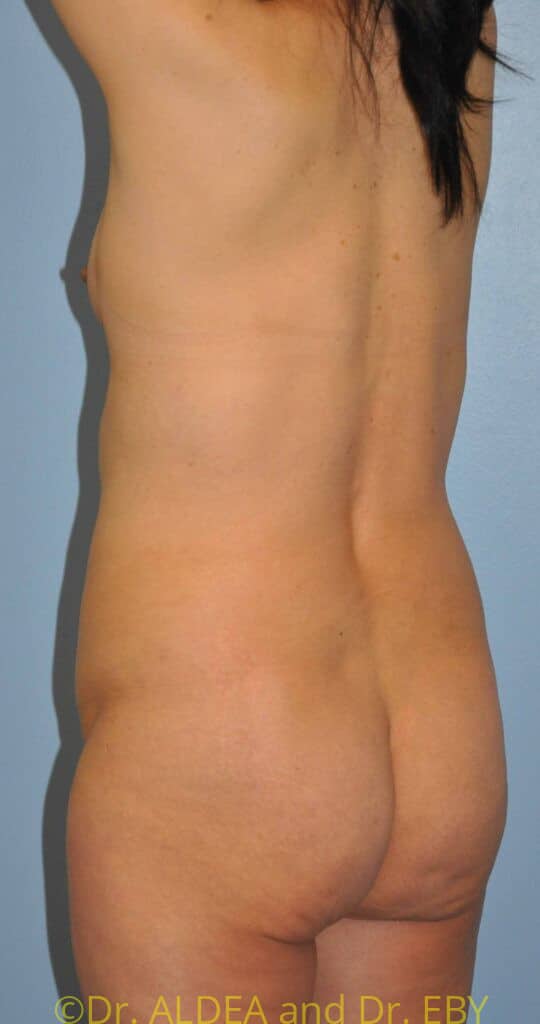 Before Image: Back Scoop Liposuction #318 - left-back-oblique