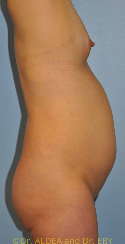 Before Image: Back Scoop Liposuction #318 - right-side
