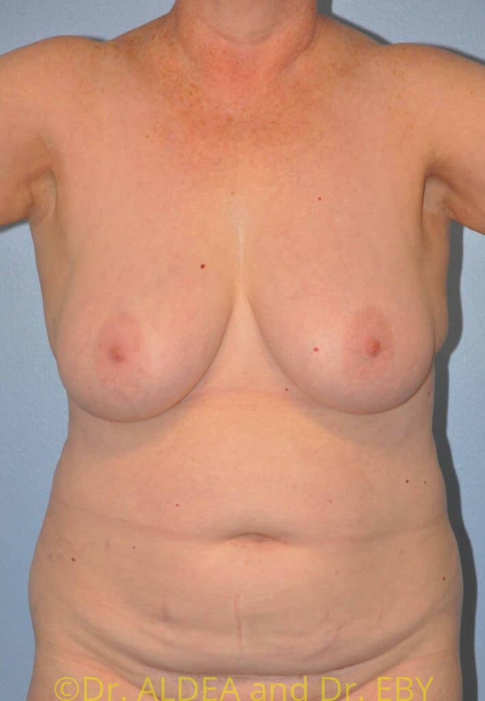 Before Image: Short Scar Breast Reduction #322 - front