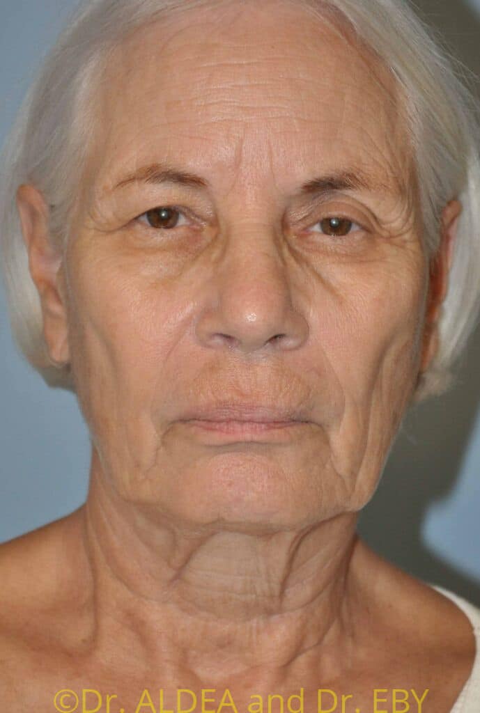 Before Image: Facelift #708 - front