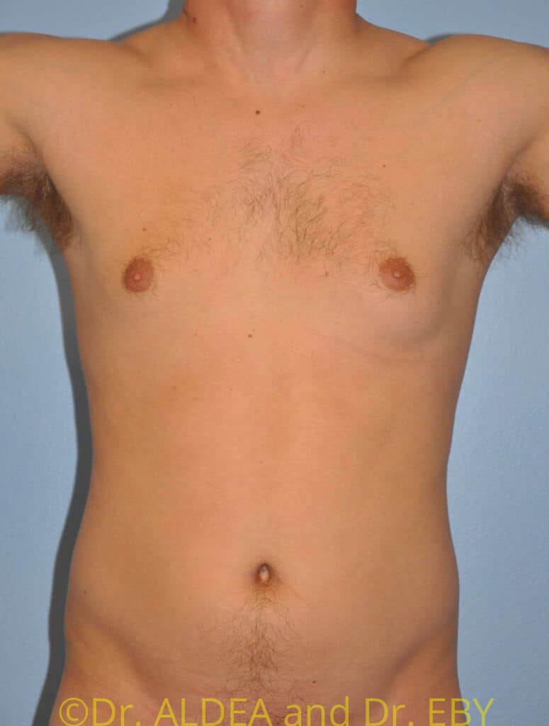 Before Image: Gynecomastia #275 - front