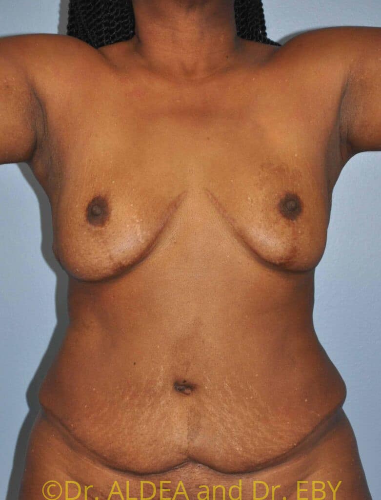 Before Image: Liposuction #772 - front