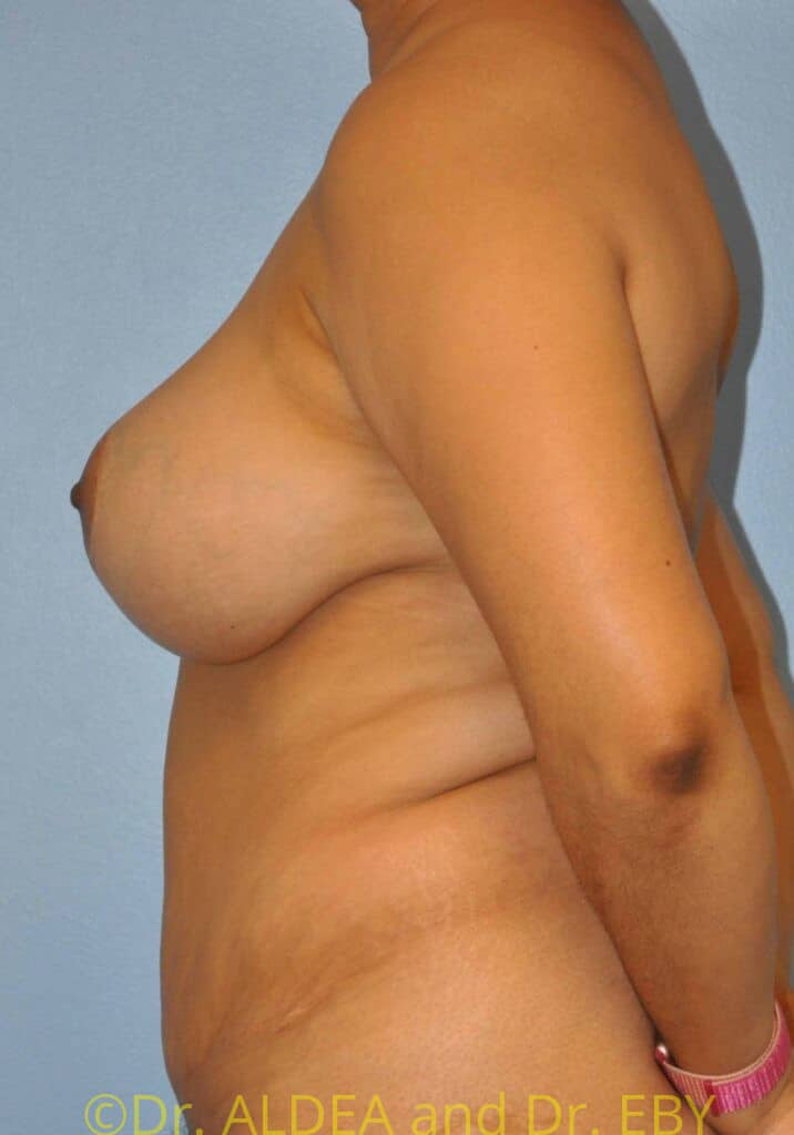After Image: Mommy Makeover #521 - left-side