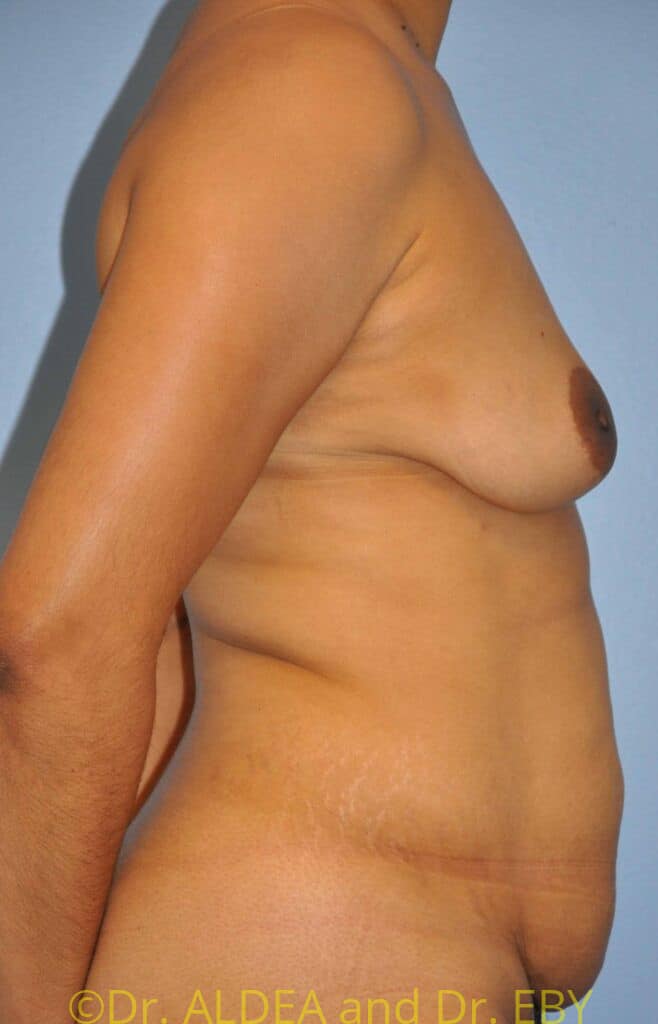 Before Image: Mommy Makeover #521 - right-side
