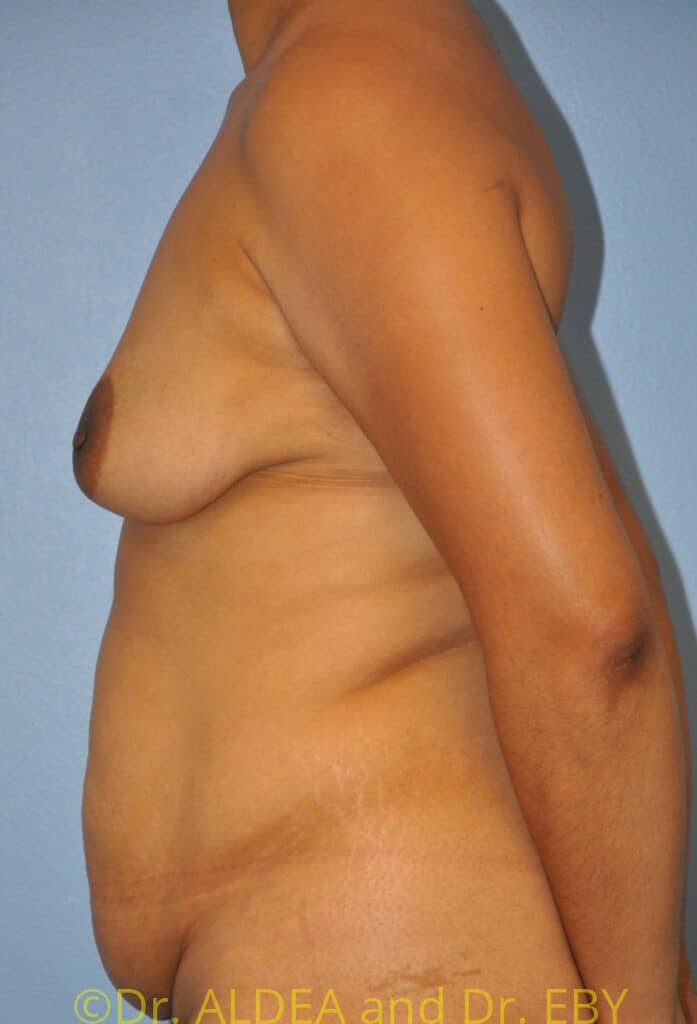 Before Image: Mommy Makeover #521 - left-side