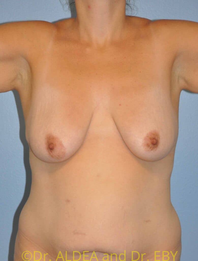 Before Image: Breast Augmentation w/ Lift #765 - front