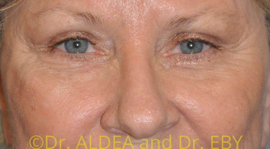 After Image: Blepharoplasty #573 - front