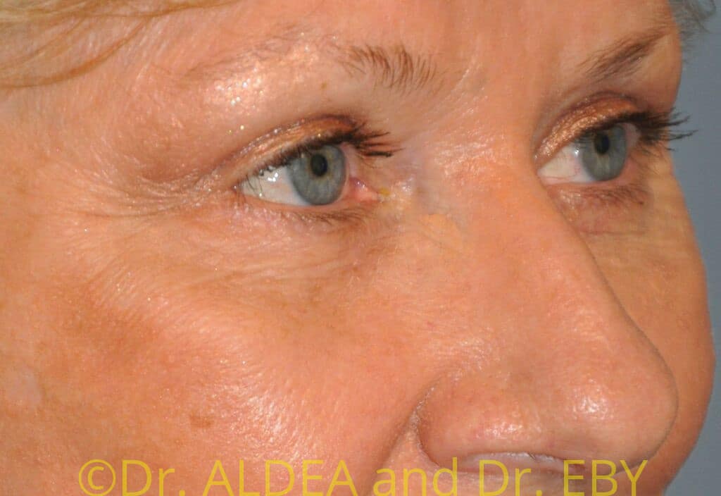 After Image: Blepharoplasty #573 - right-front-oblique