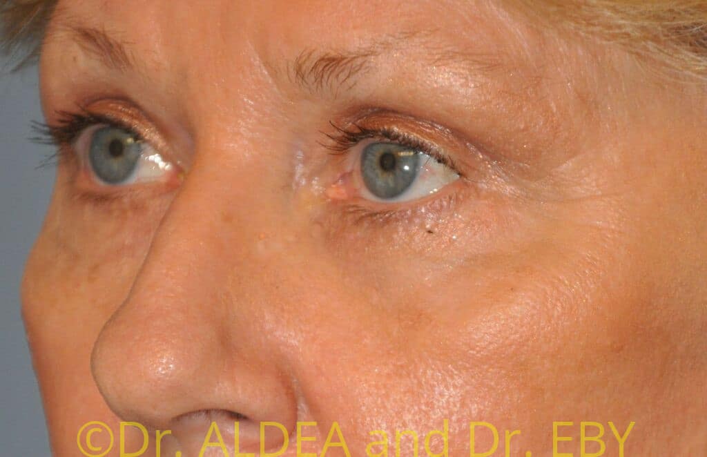 After Image: Blepharoplasty #573 - left-front-oblique