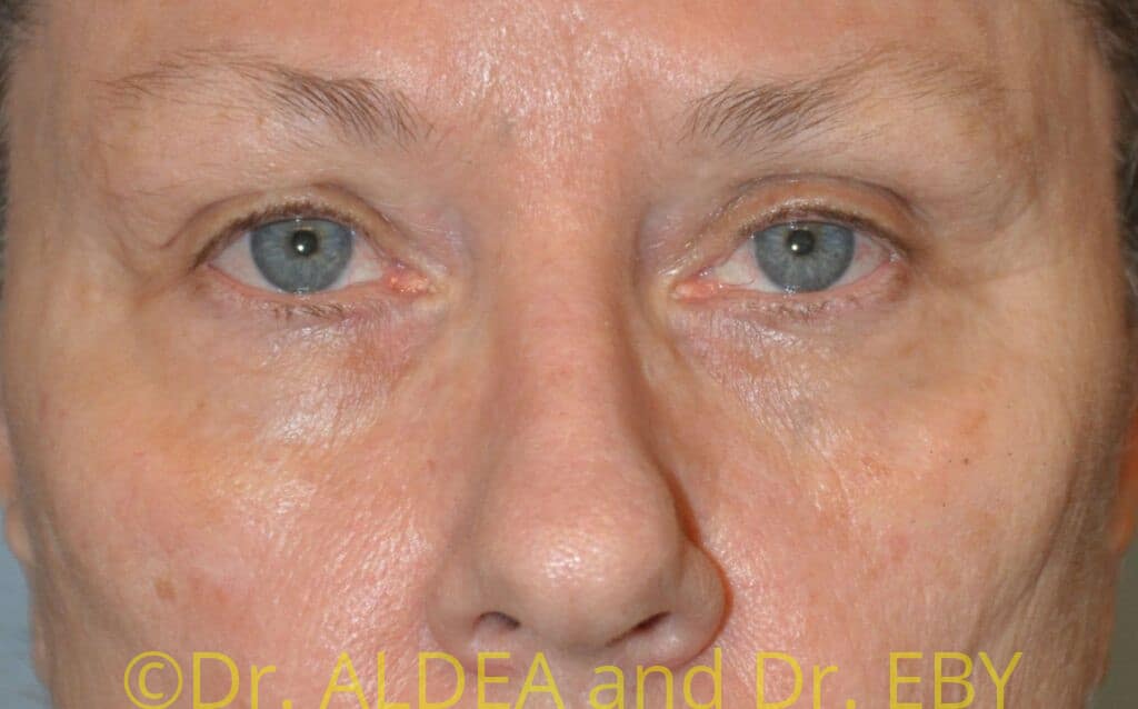 Before Image: Blepharoplasty #573 - front