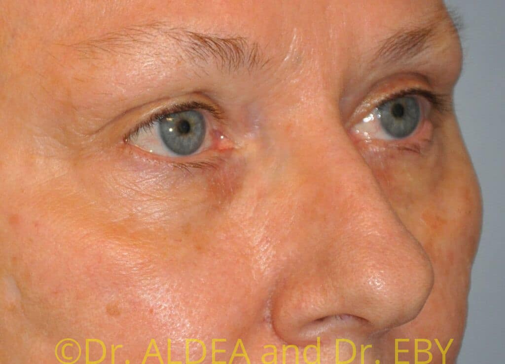 Before Image: Blepharoplasty #573 - right-front-oblique