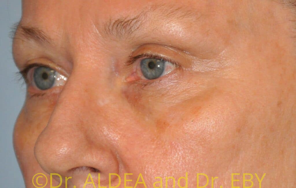 Before Image: Blepharoplasty #573 - left-front-oblique