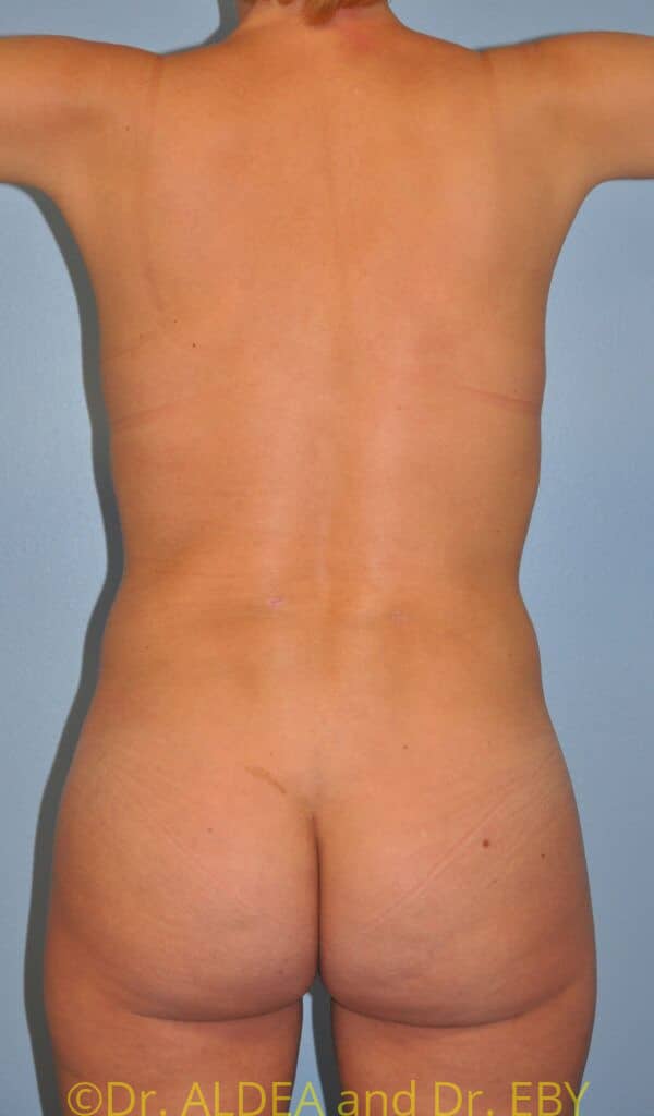 After Image: Back Scoop Liposuction #975 - back
