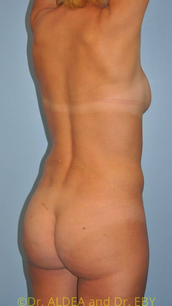After Image: Back Scoop Liposuction #975 - right-back-oblique