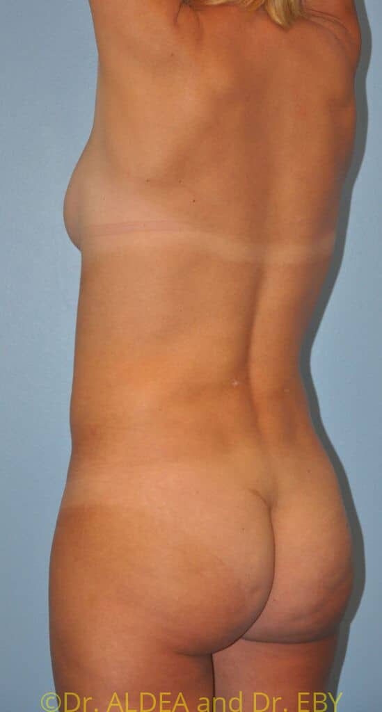 After Image: Back Scoop Liposuction #975 - left-back-oblique