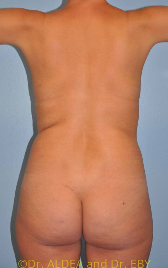 Before Image: Back Scoop Liposuction #975 - back