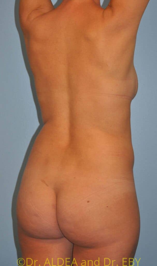 Before Image: Back Scoop Liposuction #975 - right-back-oblique
