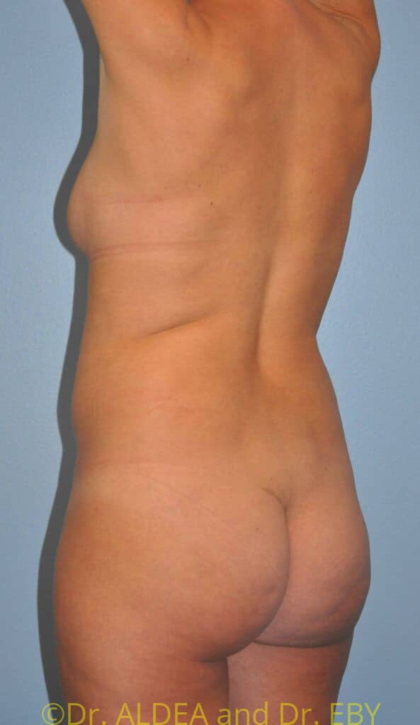 Before Image: Back Scoop Liposuction #975 - left-back-oblique