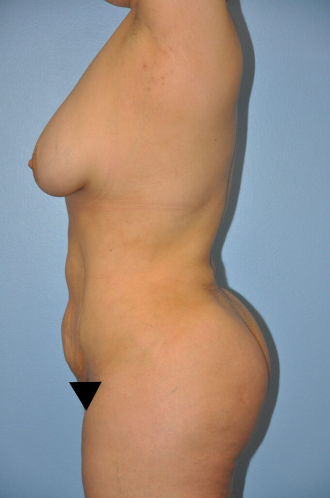 After Image: Precision BBL #560 - left-side