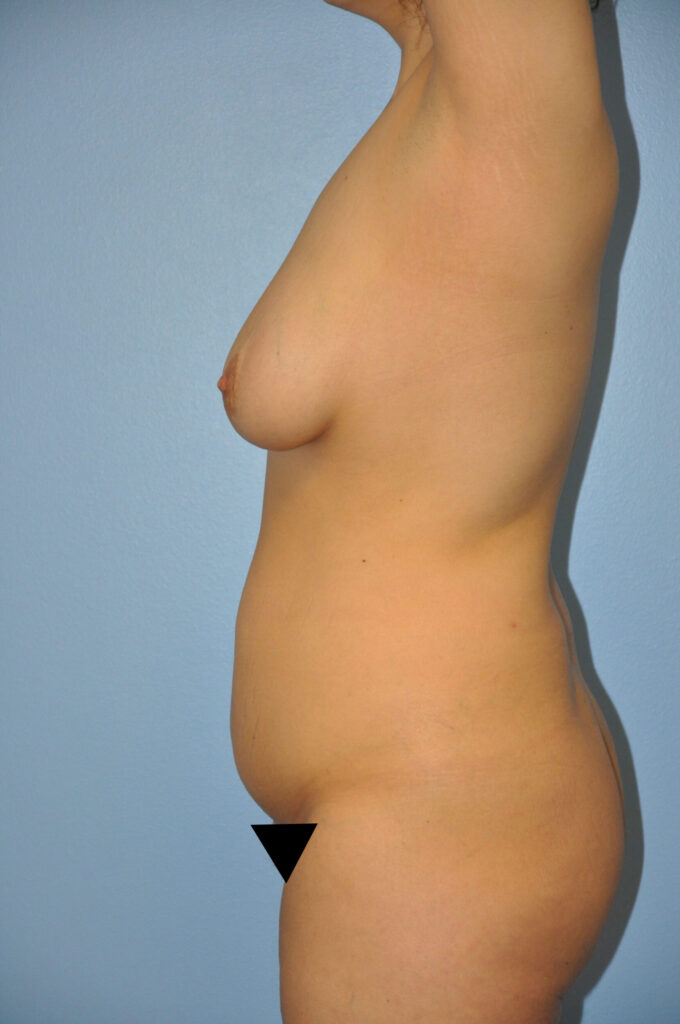Before Image: Precision BBL #560 - left-side