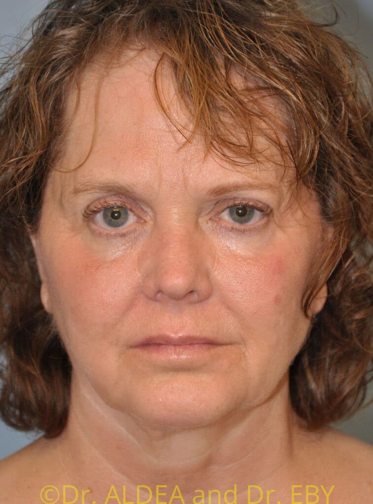 Before Image: Facelift #974 - front