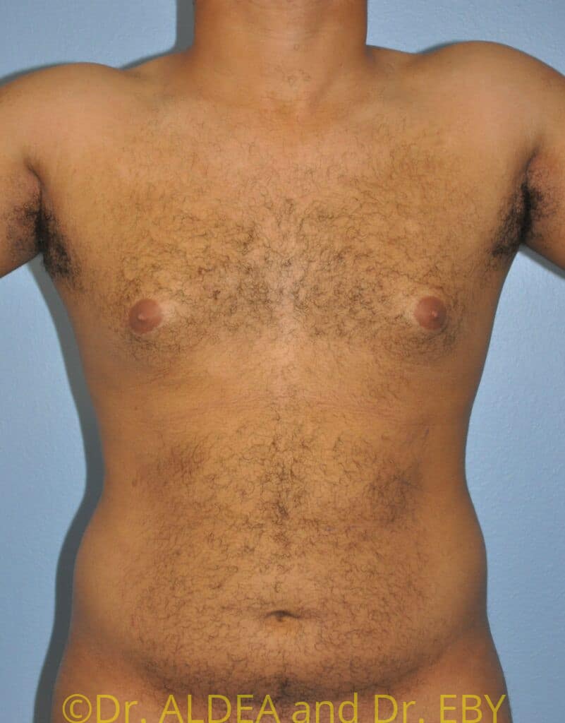 Before Image: Gynecomastia #491 - front