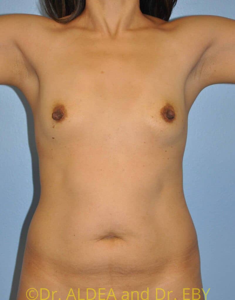 Before Image: Liposuction #265 - front