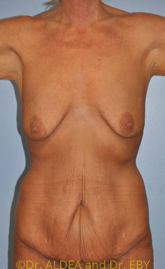Before Image: Mommy Makeover #371 - front