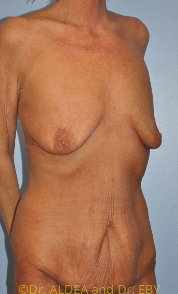 Before Image: Mommy Makeover #371 - right-front-oblique