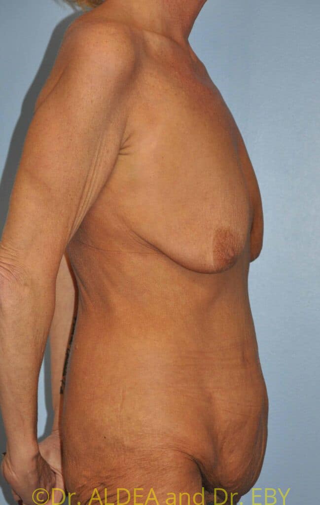 Before Image: Mommy Makeover #371 - right-side