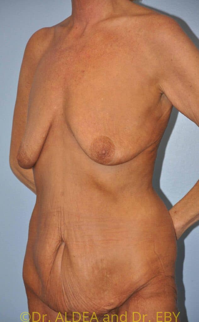 Before Image: Mommy Makeover #371 - left-front-oblique