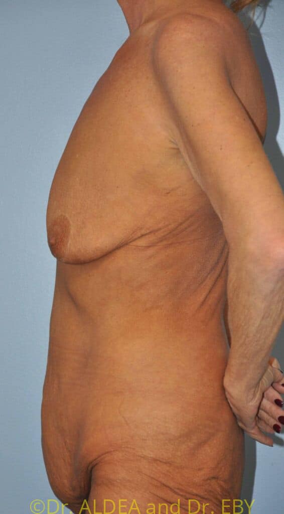 Before Image: Mommy Makeover #371 - left-side